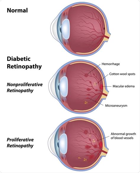 ICD kodlu diyabetik proliferatif olmayan retinopati